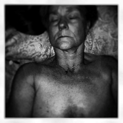 Herstorectomy