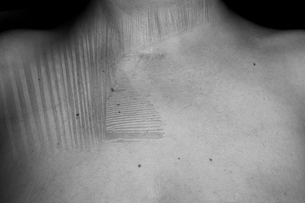 Thyroidectomy