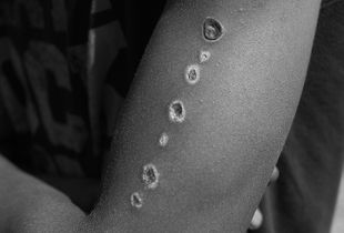 Cigarette Burns Courtesy of Macedonian Border Police, Subotica, Serbia, August 2016