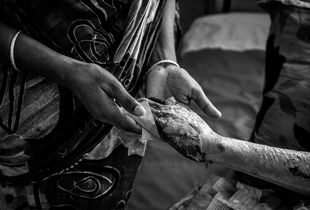 Difference, probably Sabed Ali Islam's wife can feel it better. Sabed Ali Islam is a petrol bomb victim due to the opposition parties’ blockade and strike during driving CNG.© Anik Rahman