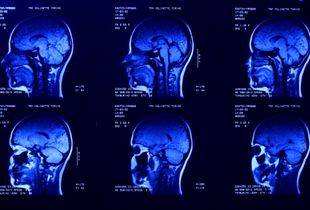 X-Ray: Blue heads, Age 17, 2019