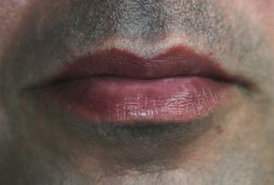 Patient/Participant                        Oratum Labia
