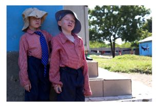Albinos Boys