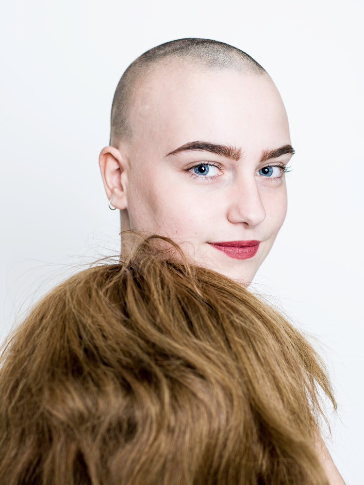 Alopecia 