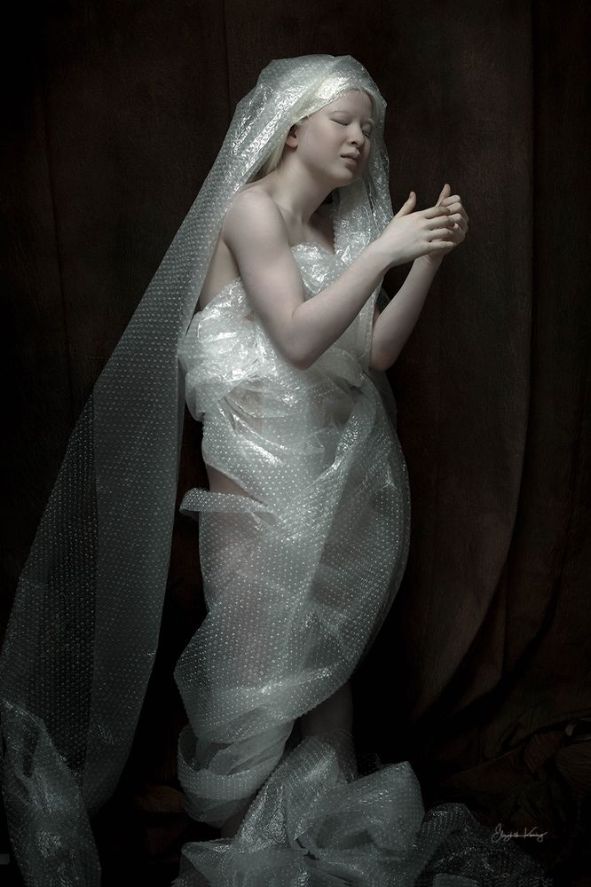  albinism