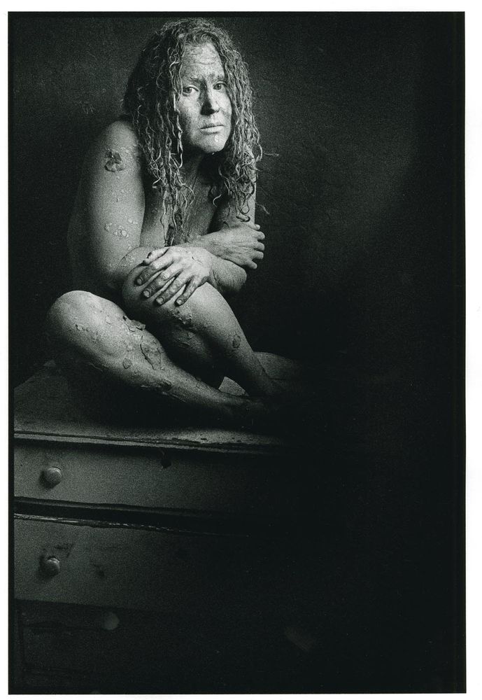Scar Tissue