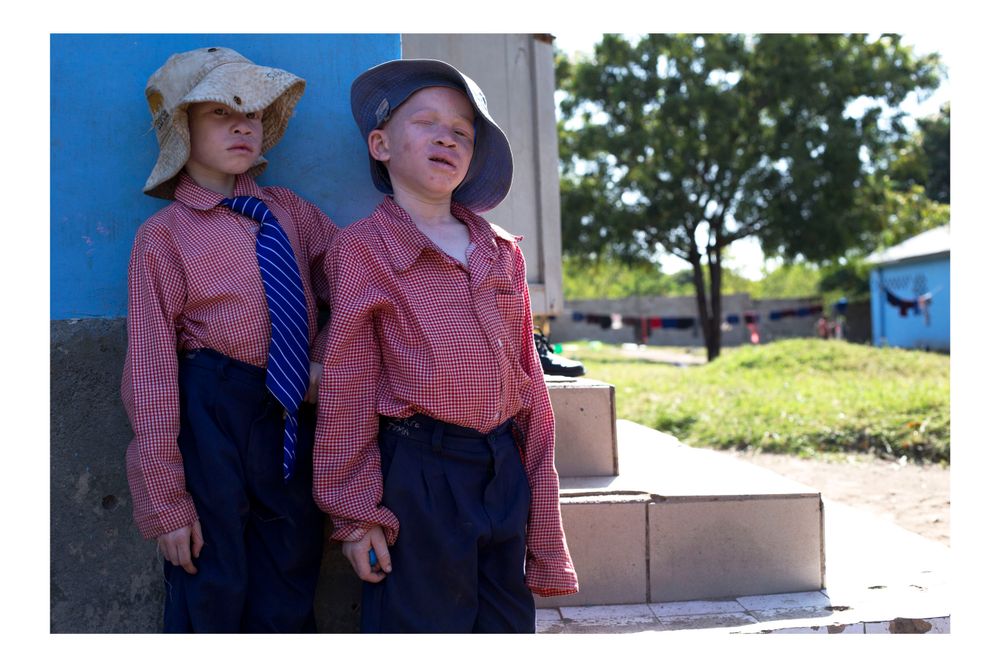 The life of the children Albino in Tanzania