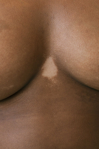 Detail of vitiligo skin - Shades of Pale