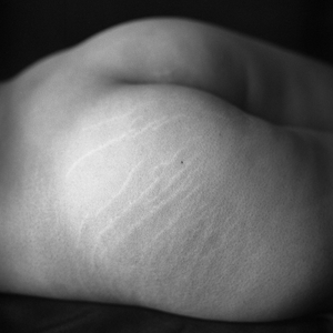 5. Stretch Mark