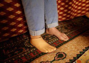 Refugee Prosthetics