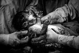 Caesarean 3