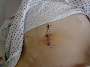 One of Dad's surgery scars.