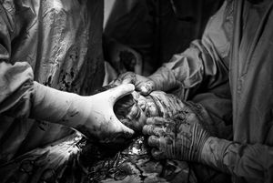 Caesarean 2