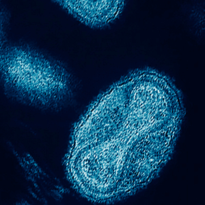 Smallpox
