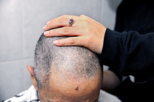 Tsila preparing for treatment