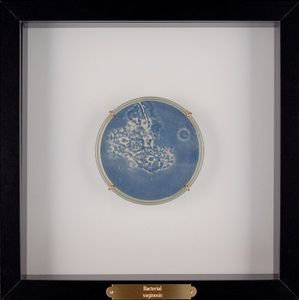 Bacterial vaginosis