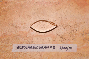Echocardiogram #3