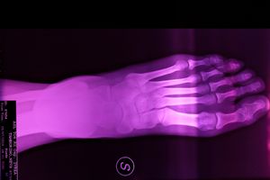 X-Ray: Purple foot, Age 36, 2019