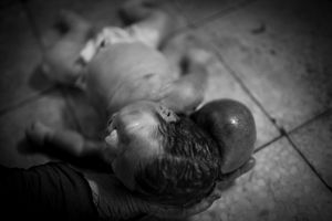 © Christian Werner - Iraq, Basra, 24 April 2012 – The corpse of a child, with a head-sized tumor at the base of it’s neck. He was delivered dead.