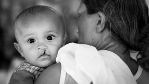 Operation Smile