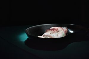 Cancer related amputation of a hand