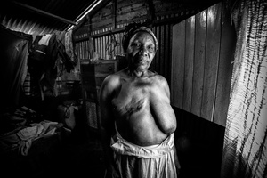 Cancer in Africa