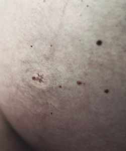 Untitled II (Skin Studies series)