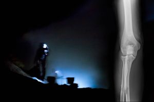 Broken elbow