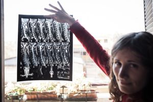 Mere shows a cervical  MRI scan she made in 2004. The clinical study  helped her  to undertake the botulinum toxin A therapy for the tension-type and cervicogenic headache.. © Riccardo Budini / UnFrame