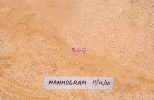 Mammogram