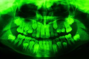 X-Ray: Green teeth, Age 8, 2019
