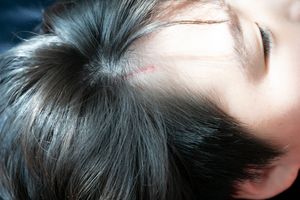 Scar
