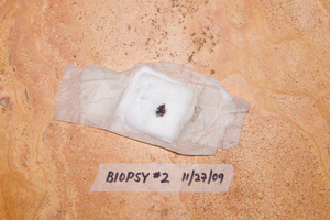 Biopsy #2
