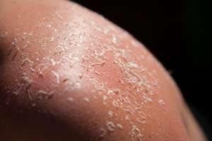 Sunburn